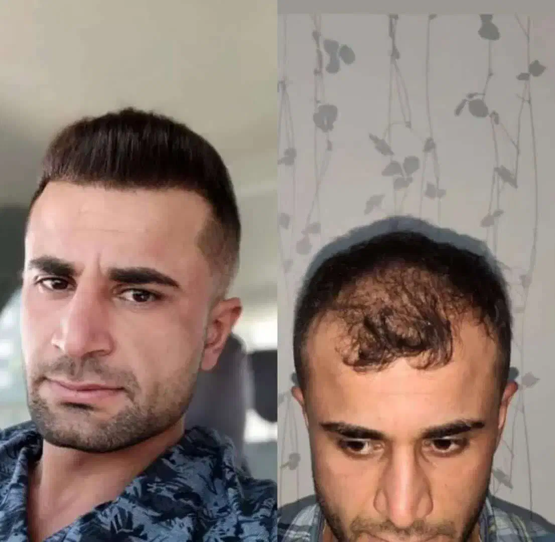 کاشت مو ابرو ریش تارکوب|خدمات آرایشگری و زیبایی|بیجار, |دیوار