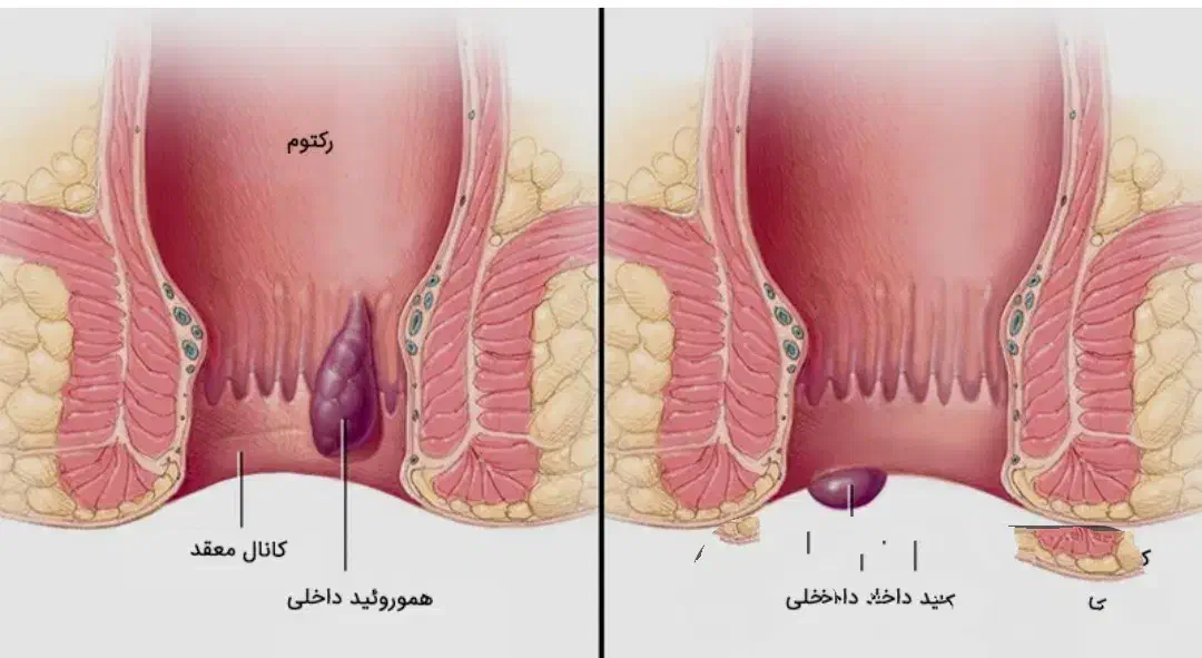 بواسیر شقاق یبوست|آرایشی، بهداشتی، درمانی|میاندوآب, |دیوار