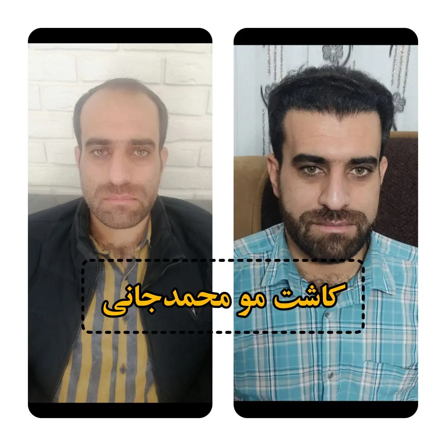 کاشت مو و ابرو و ریش|خدمات آرایشگری و زیبایی|ارسنجان, |دیوار