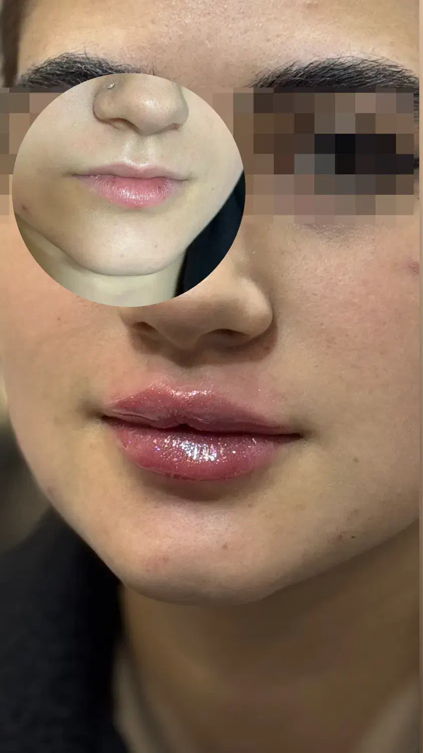 تزریق ژل و بوتاکس|خدمات آرایشگری و زیبایی|ارومیه, |دیوار