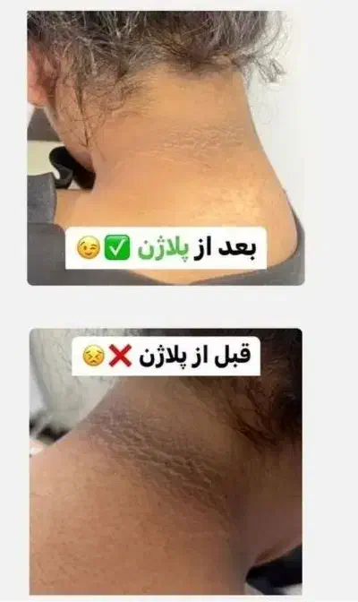 پلاژن روشن سازی|آرایشی، بهداشتی، درمانی|شیراز, معالیآباد|دیوار