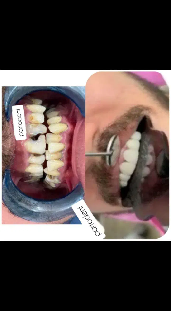 کامپوزیت در منزل. ایذه، باغملک، هفتکل|خدمات آرایشگری و زیبایی|ایذه, |دیوار