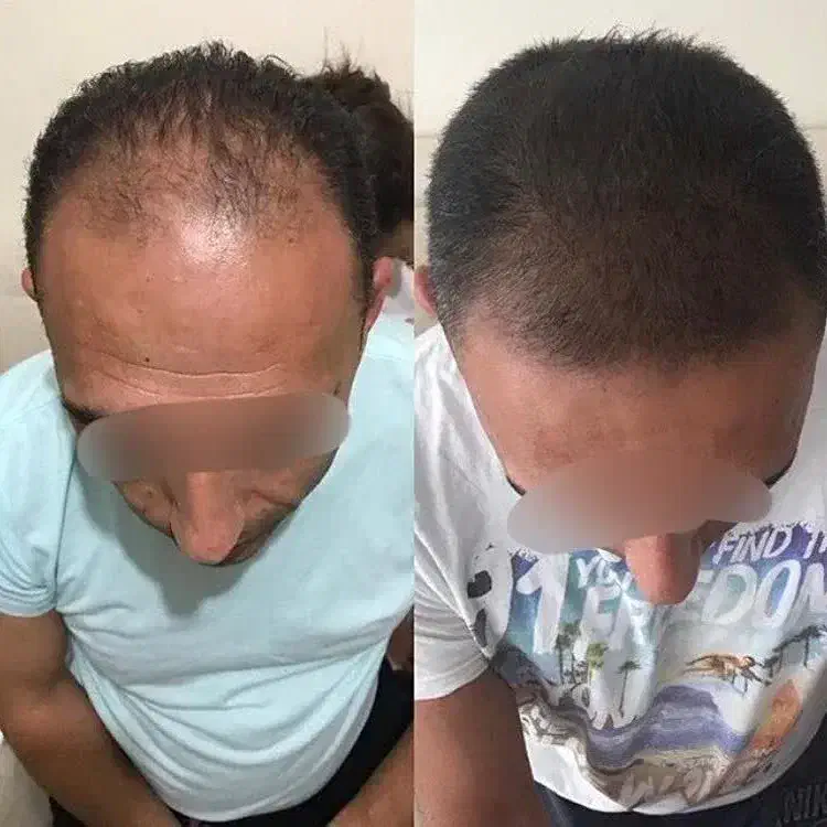 قطع ریزش مو و پرپشتی مو فقط با تکنیک اکسونیک|آرایشی، بهداشتی، درمانی|بوشهر, |دیوار