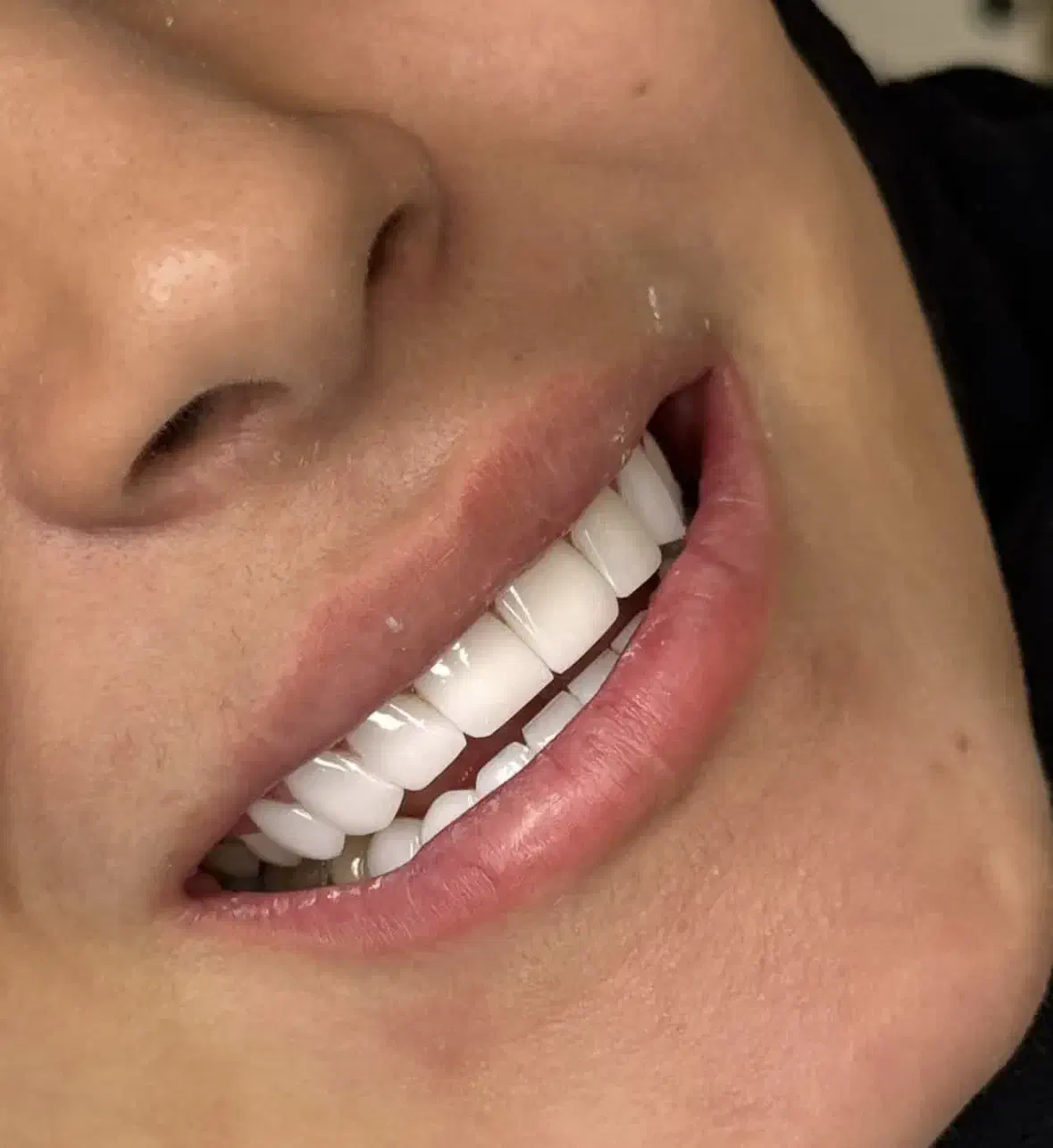 کامپوزیت دندان اقساطی بدون بهره|خدمات آرایشگری و زیبایی|اصفهان, عسگریه|دیوار