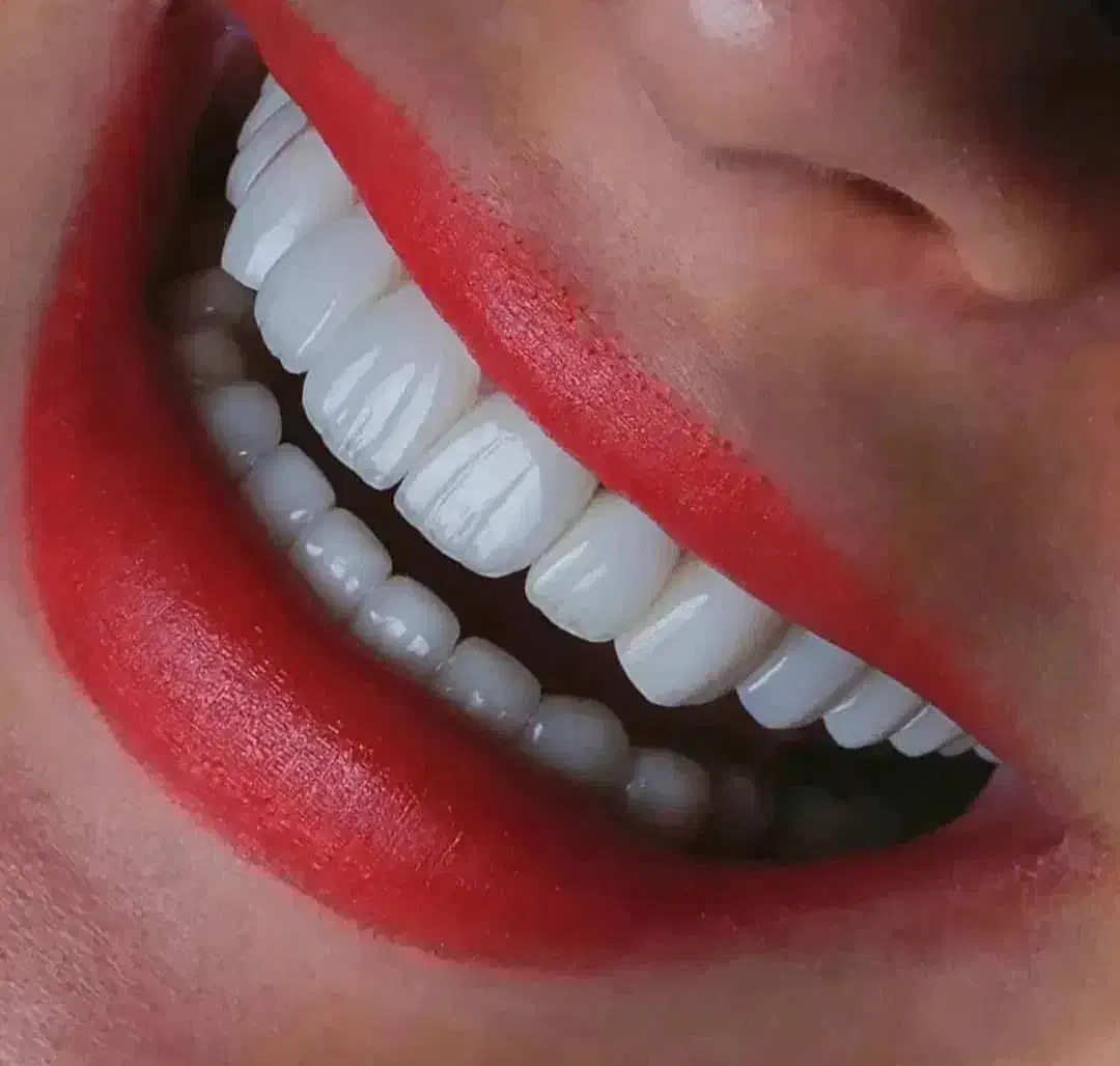 دندانپزشکی ، ایمپلنت، روکش، کامپوزیت ، عصب کشی|خدمات آرایشگری و زیبایی|کوهدشت, |دیوار