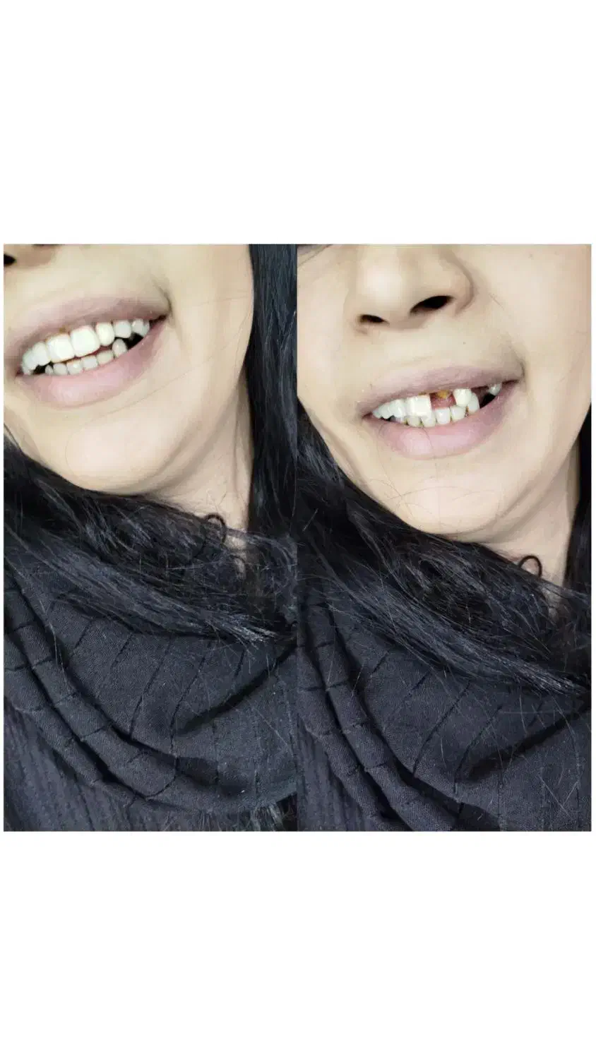 جشنواره دندان مصنوعی خارجی ژله ای با بیمه وضمانت|خدمات آرایشگری و زیبایی|کرج, مصباح|دیوار