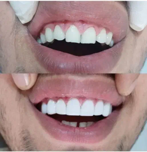 دندانپزشکی دندانسازی روکش|خدمات آرایشگری و زیبایی|نورآباد, |دیوار