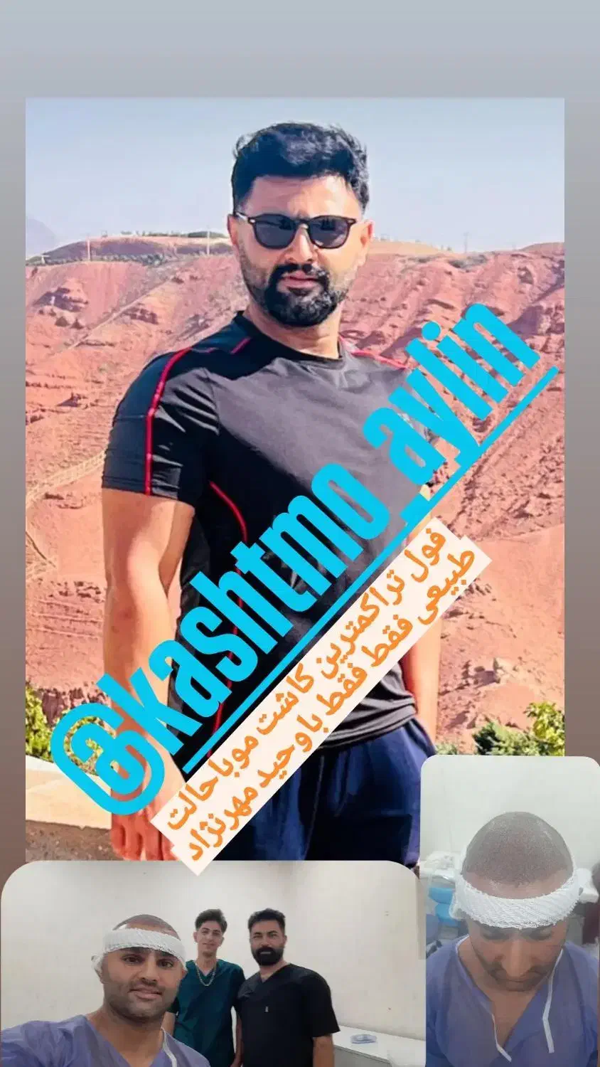 کاشت مو ابروبابروزترین متدروزدنیا|خدمات آرایشگری و زیبایی|خوی, |دیوار