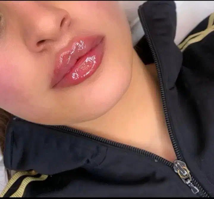 تخفیفات بلک فرایدی ژل و بوتاکس درمطب|خدمات آرایشگری و زیبایی|خرم‌آباد, |دیوار