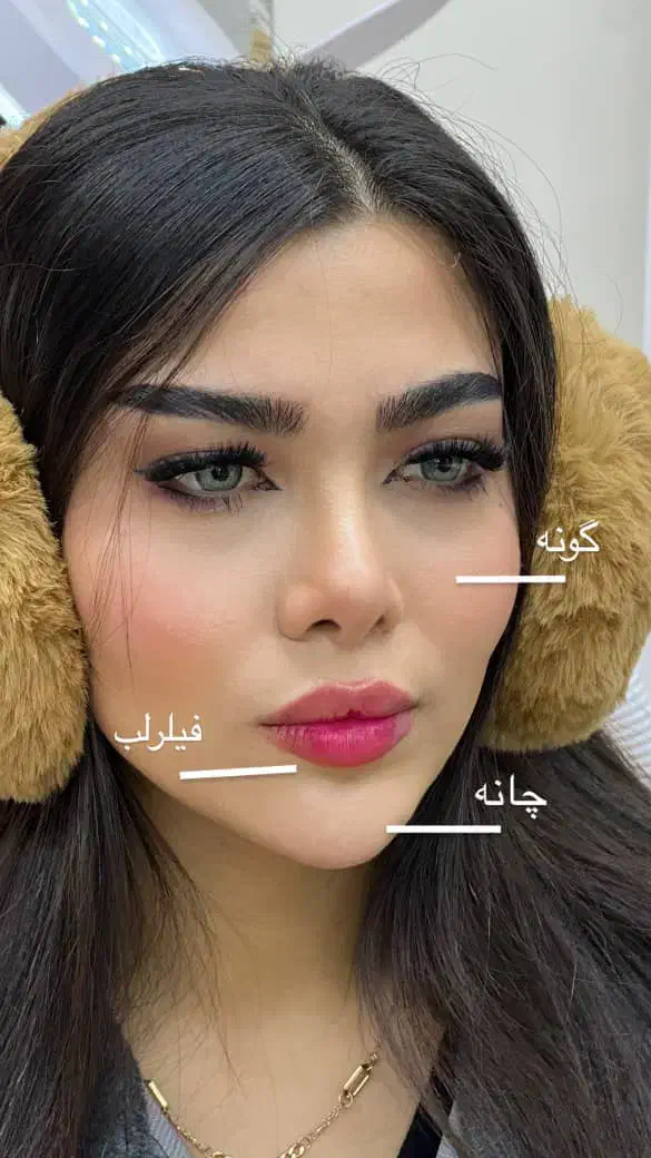 جشنواره تخفیف تزریق ژل و بوتاکس کانتورینگ فیشیال|خدمات آرایشگری و زیبایی|کرج, گلشهر|دیوار