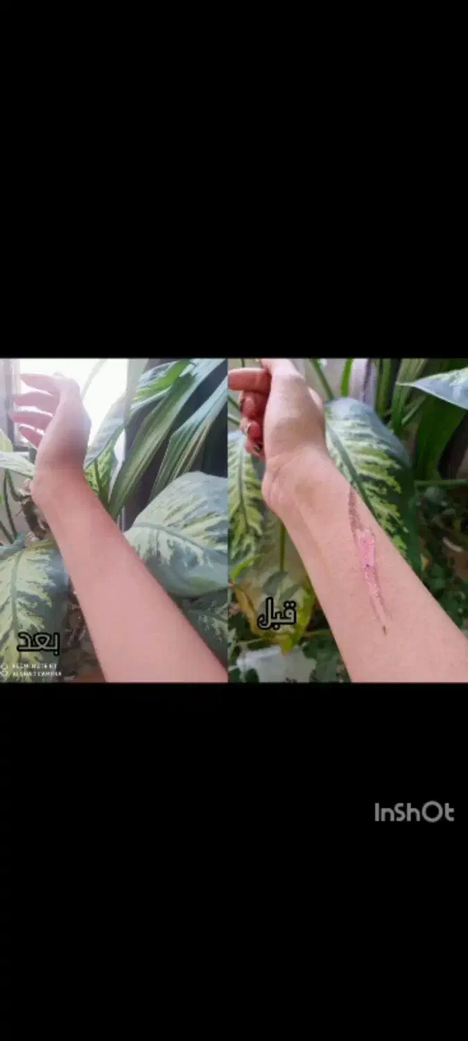 ترمیم زخم سوختگی|آرایشی، بهداشتی، درمانی|قم, حنیف نژاد|دیوار