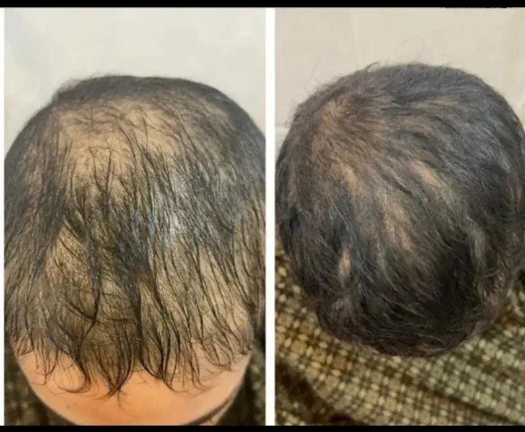 جشنواره یلدایی کاشت مو ، ابرو و مزوتراپی و prp|خدمات آرایشگری و زیبایی|زنجان, |دیوار