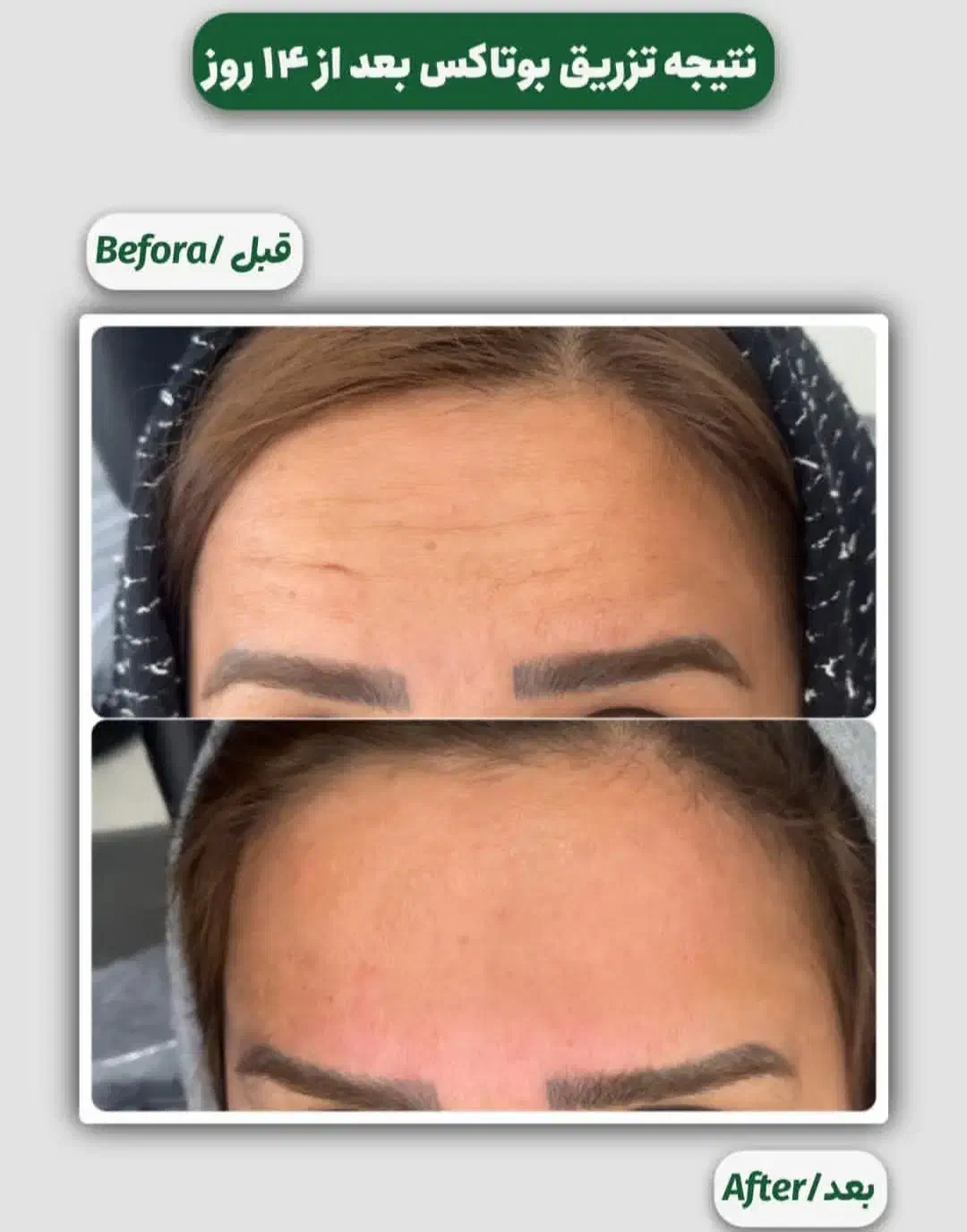 اف ویژه بوتاکس تعداد محدود|خدمات آرایشگری و زیبایی|یاسوج, |دیوار
