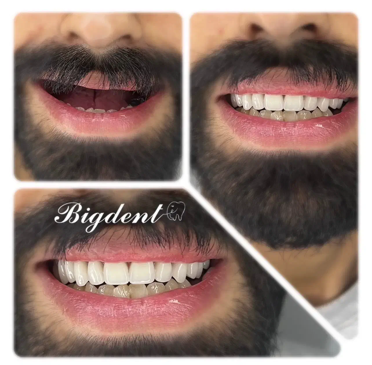 دندان مصنوعی تخفیف تا شب یلدا برای ۵ نفر قیمت ویژه|آرایشی، بهداشتی، درمانی|تبریز, |دیوار