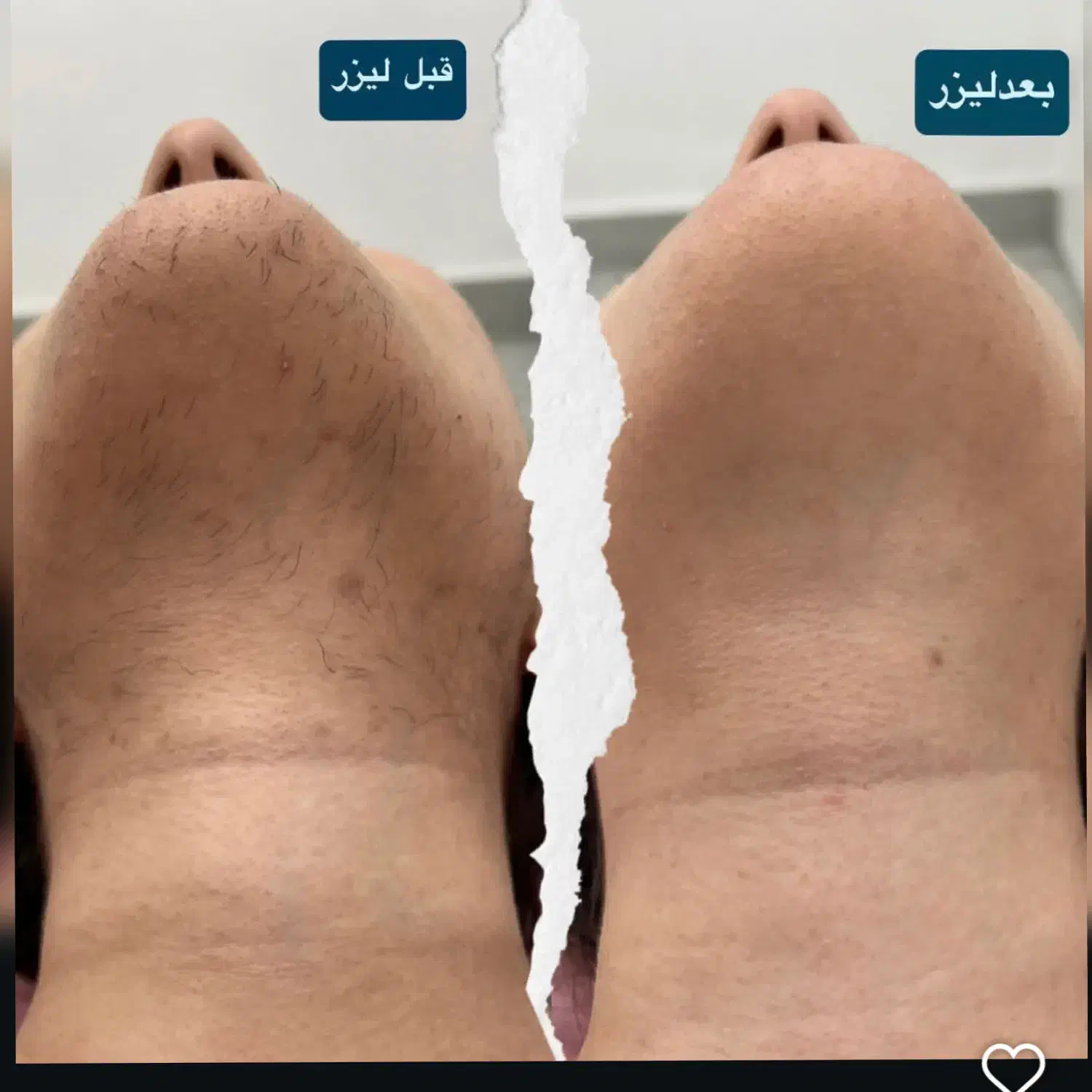 لیزرموهای زائد|خدمات آرایشگری و زیبایی|سرپل ذهاب, |دیوار