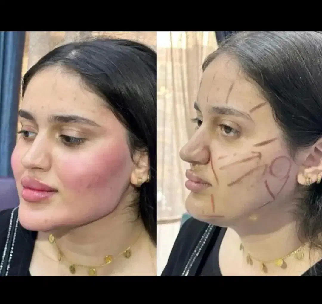 بوتاکس وفیلر صورت و بدن|خدمات آرایشگری و زیبایی|بیرجند, |دیوار