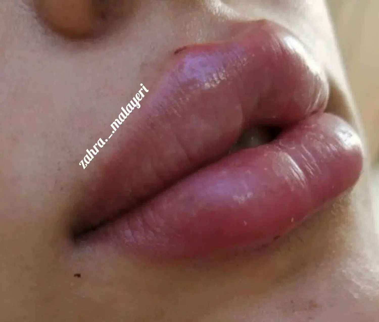 تزریق ژل فیلر تضمینی بوتاکس پرسینگ چاله گونه|خدمات آرایشگری و زیبایی|قم, نیروگاه|دیوار