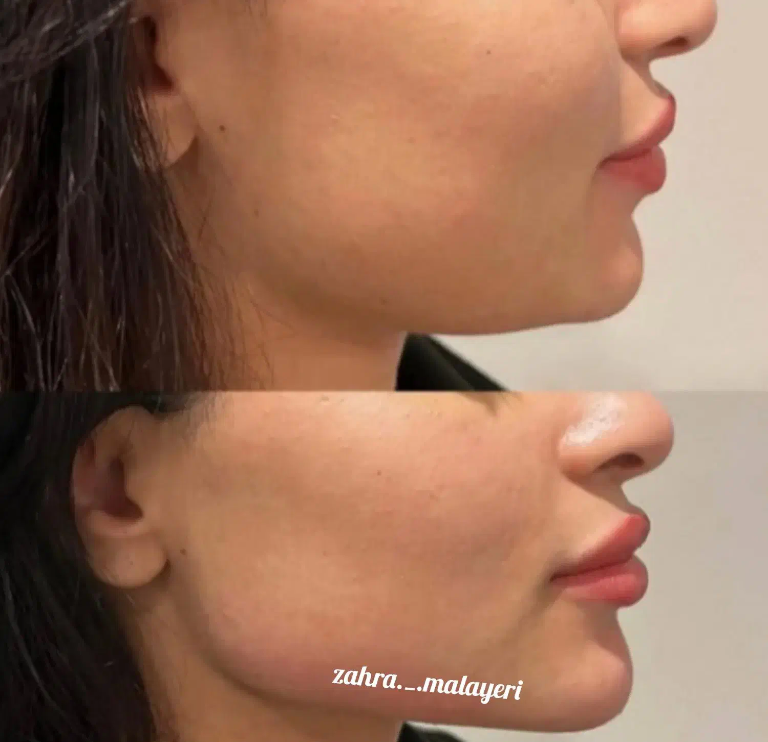 تزریق ژل فیلر تضمینی بوتاکس پرسینگ چاله گونه|خدمات آرایشگری و زیبایی|قم, نیروگاه|دیوار