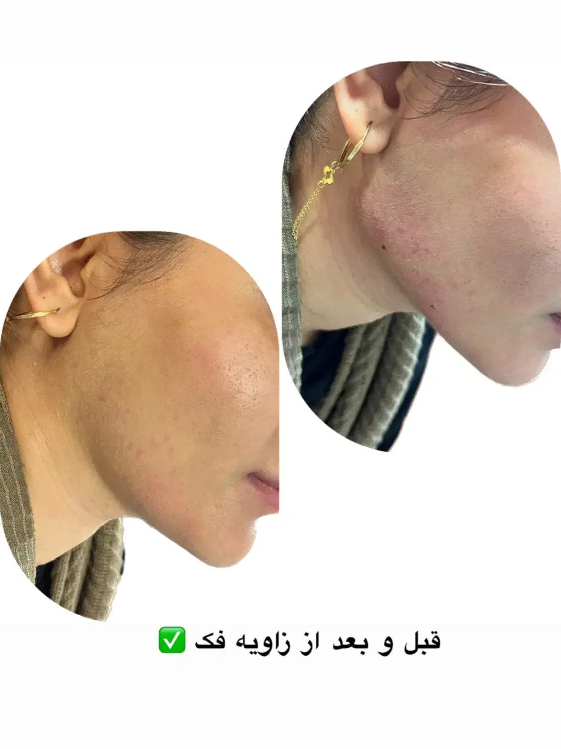 تزریق فیلر و بوتاکس و نخ توسط دستیار پزشک|خدمات آرایشگری و زیبایی|خرمشهر, |دیوار