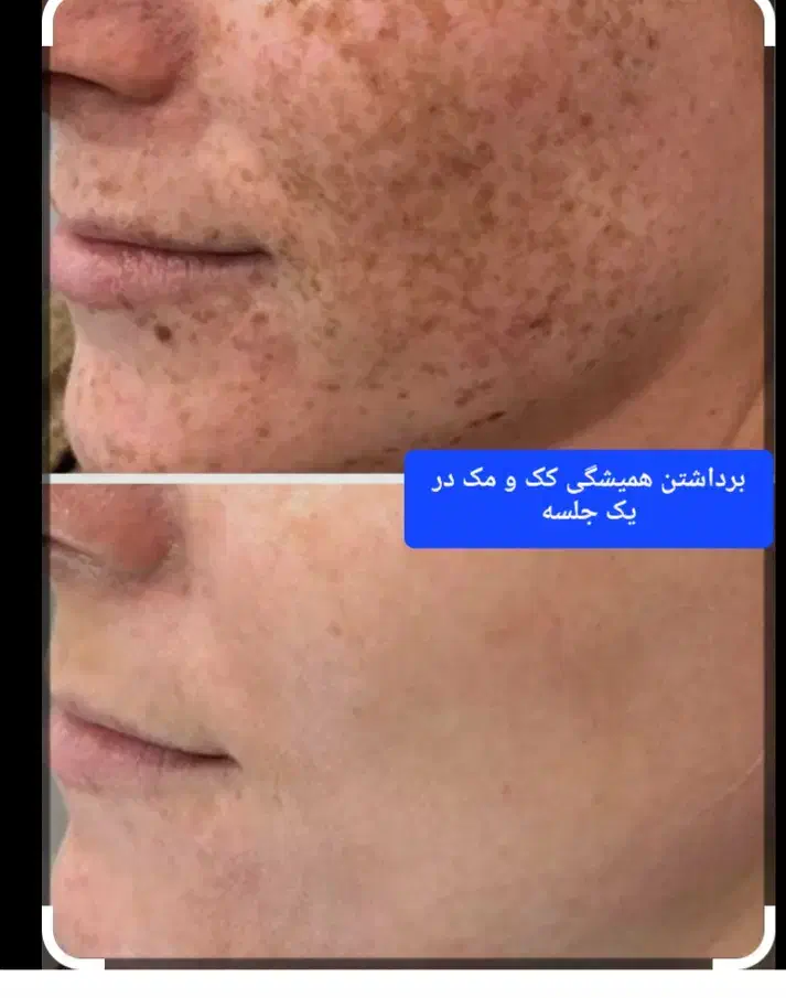 جشنواره رفع همیشگی کک ومک در۱ جلسه دونه ای۳۰ هزارت|خدمات آرایشگری و زیبایی|اصفهان, دشتستان|دیوار