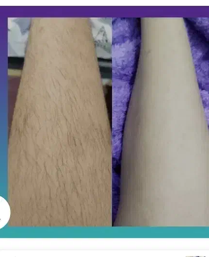 اپیلاسیون ویژه بانوان.موخوره گیری با دستگاه|خدمات آرایشگری و زیبایی|نیشابور, شهرک اندیشه|دیوار