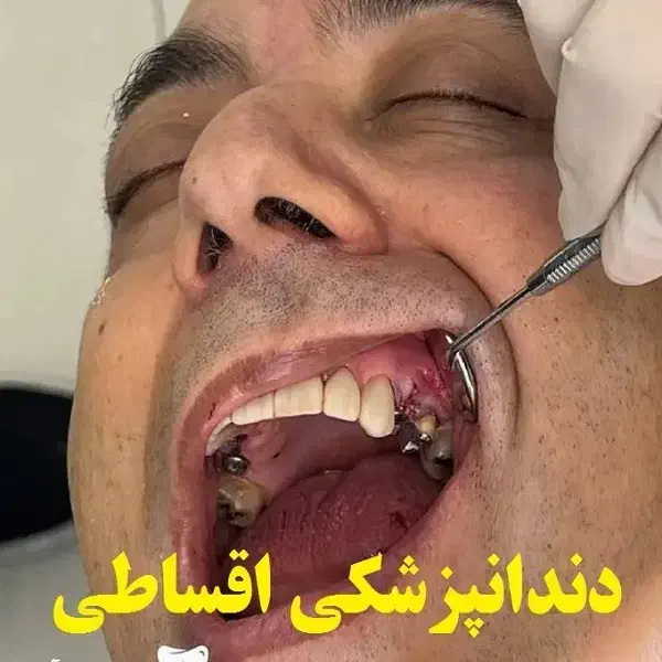 دندانپزشک اقساط کامپوزیت لمینیت لب شیشه ای بلیچینگ|خدمات آرایشگری و زیبایی|مشهد, سجاد شهر|دیوار