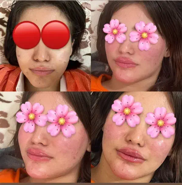 ژل بوتاکس پیرسینگ مزوژل آنزیم آموزش|خدمات آرایشگری و زیبایی|اسلام‌‌آباد غرب, |دیوار