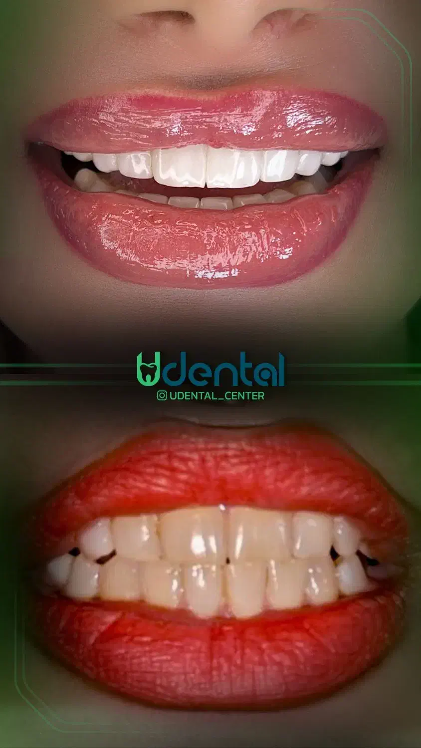 کامپوزیت، لمینت، ایمپلنت اقساط ویژه|خدمات آرایشگری و زیبایی|تاکستان, |دیوار