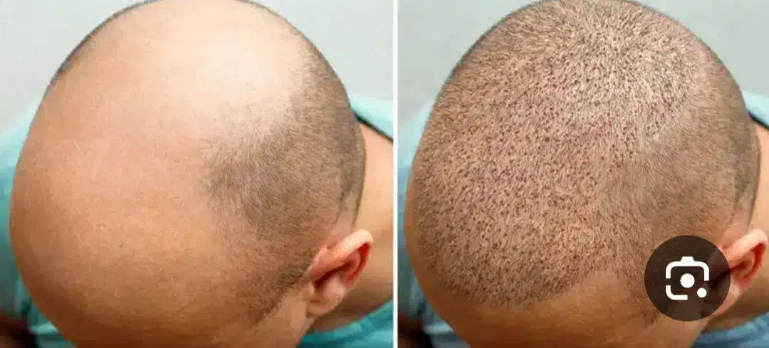 کاشت مو|فعالیت داوطلبانه|بهبهان, |دیوار