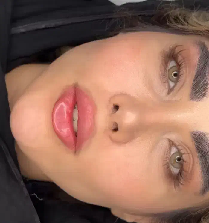 تزریق تخصصی ژل کانتورینگ صورت وزاویه فک وفیشیال|خدمات آرایشگری و زیبایی|کرج, گلشهر|دیوار