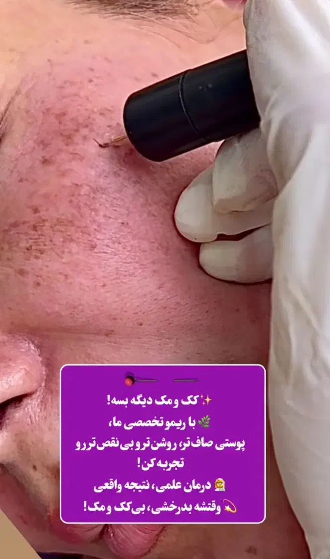 فروش دستگاه نانو الکترولیز برداشتن کک و مک|آرایشگاه و سالن‌های زیبایی|مشهد, نیروی هوایی|دیوار