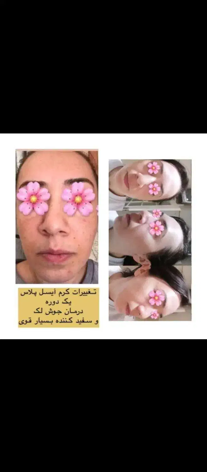 فرمول سفید کننده قوی پوست|آرایشی، بهداشتی، درمانی|ایرانشهر, |دیوار