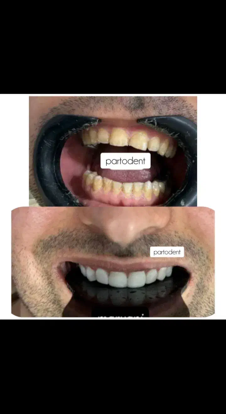 کامپوزیت در منزل. ایذه، باغملک، هفتکل|خدمات آرایشگری و زیبایی|ایذه, |دیوار