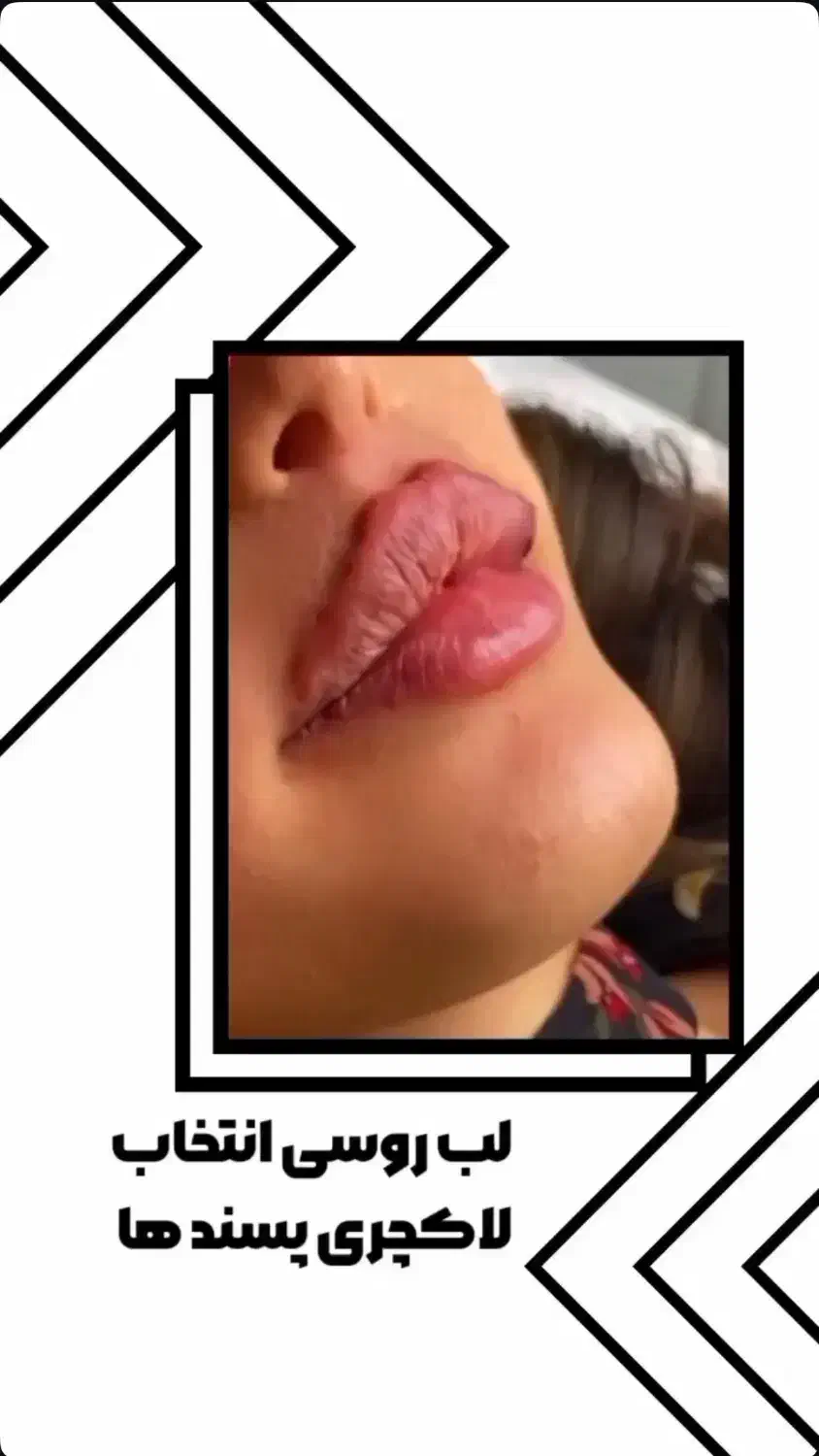 تخفیف ویژه خدمات ژل و بوتاکس|خدمات آرایشگری و زیبایی|زابل, |دیوار