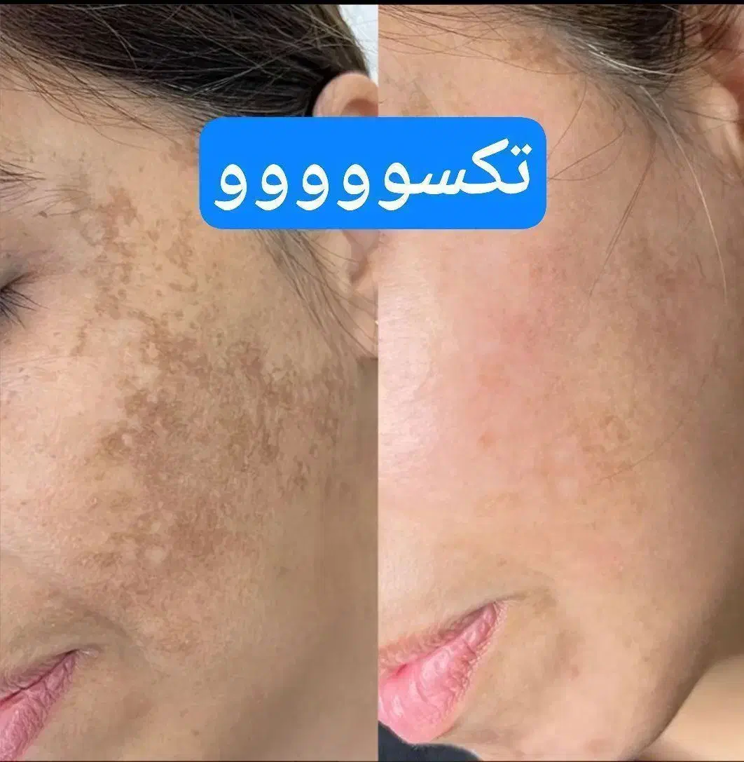 پوست کره ای|خدمات آرایشگری و زیبایی|ارومیه, |دیوار