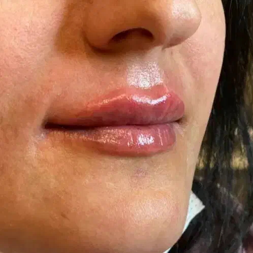 تزریق تخصصی ژل و بوتاکس|خدمات آرایشگری و زیبایی|اصفهان, زاجان|دیوار