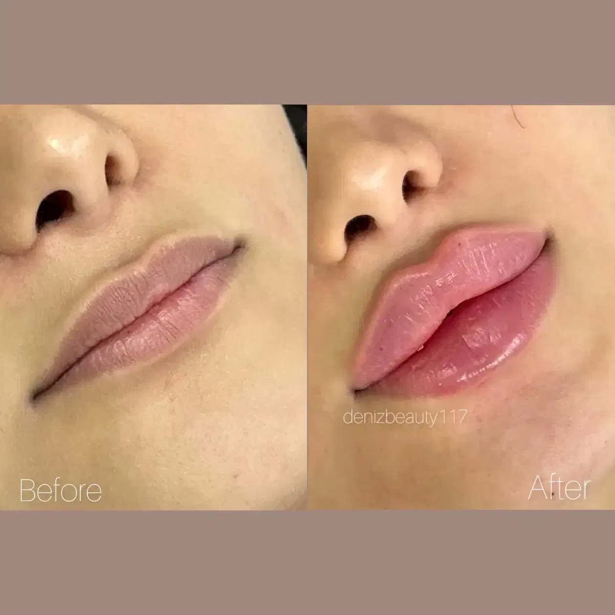 جشنواره تزریق ژل و بوتاکس (توسط پزشک)|خدمات آرایشگری و زیبایی|اصفهان, عباسآباد|دیوار