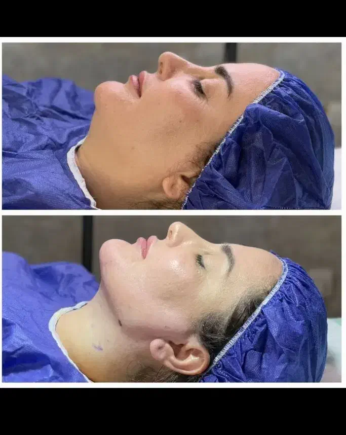 مرکزلیپوساکشن و ساکشن غبغب و زاویه سازی توسط جراح|خدمات آرایشگری و زیبایی|مشهد, سناباد|دیوار