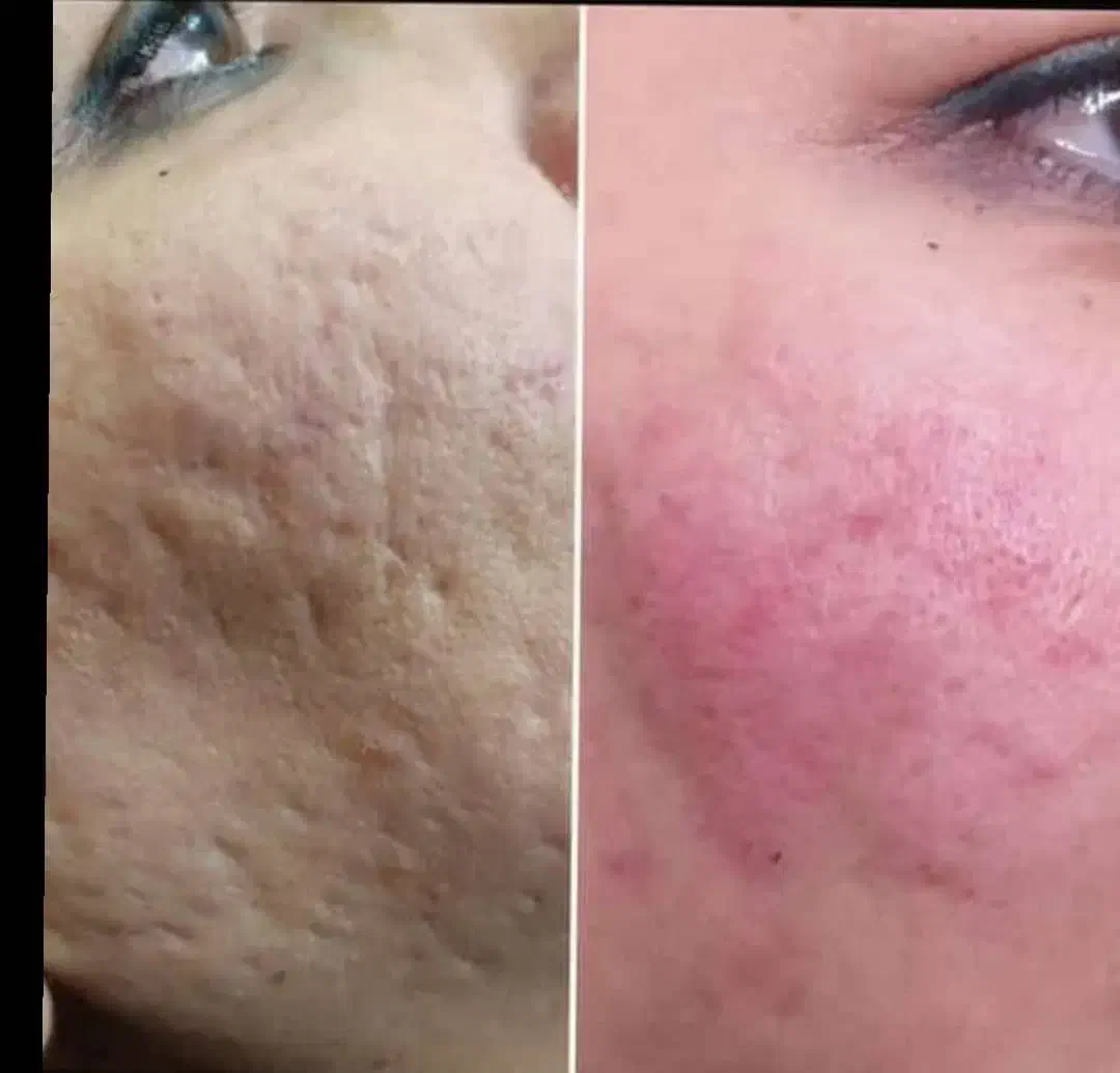 تخفیف ویژه بوتاکس، ژل، پی آر پی، رفع کک و مک|خدمات آرایشگری و زیبایی|بوکان, |دیوار