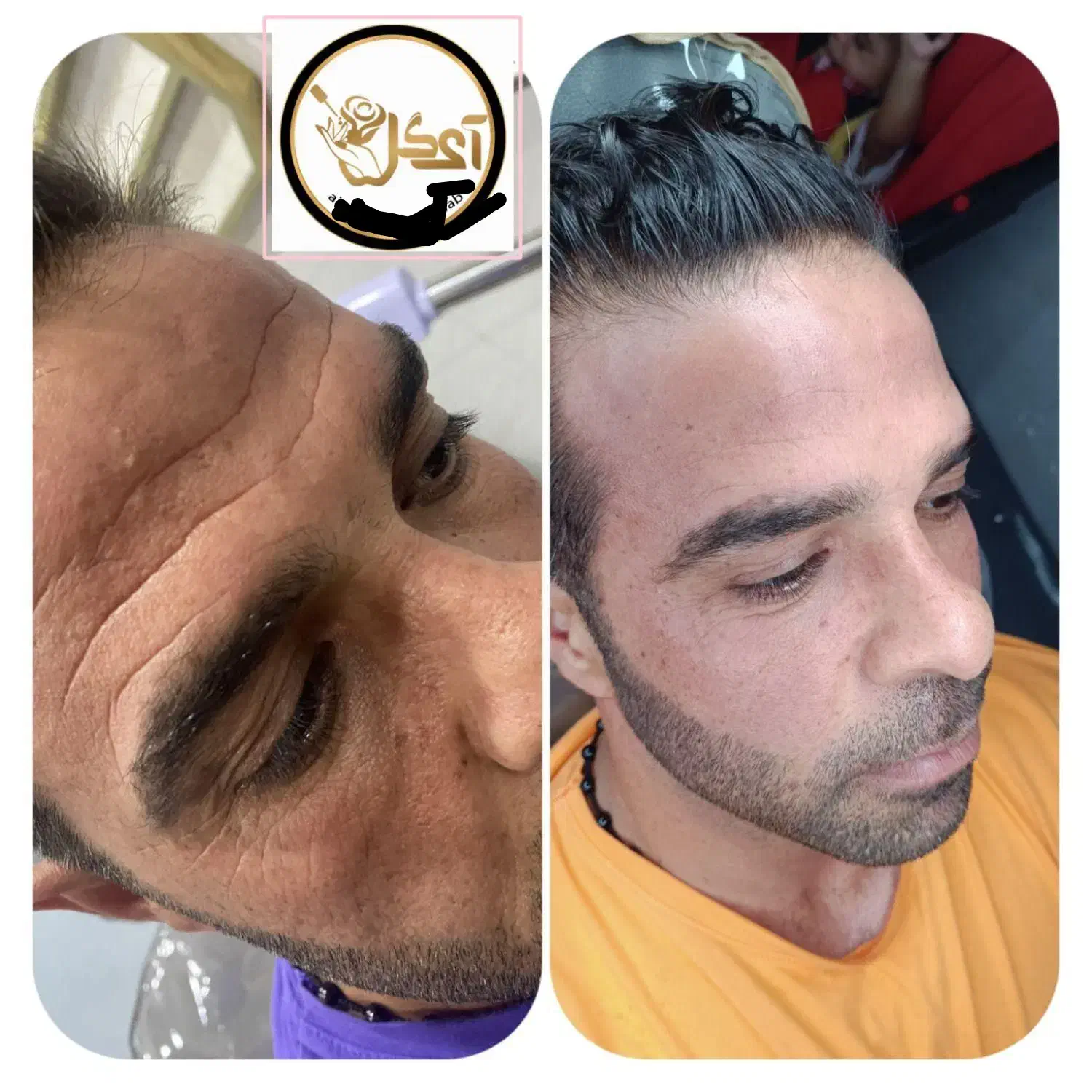 تزریق ژل،بوتاکس،آنزیم،پی آر پی، مزو ژل برای آقایان|خدمات آرایشگری و زیبایی|خرمشهر, |دیوار