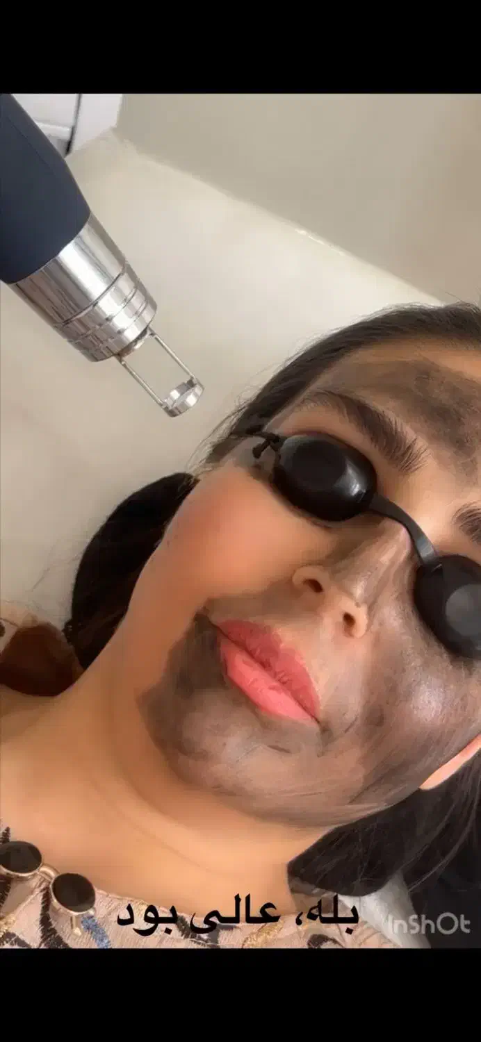 پاک کردن تتو،برداشتن خال،بوتاکس،فیلر،ژل|خدمات آرایشگری و زیبایی|کرج, گوهردشت|دیوار