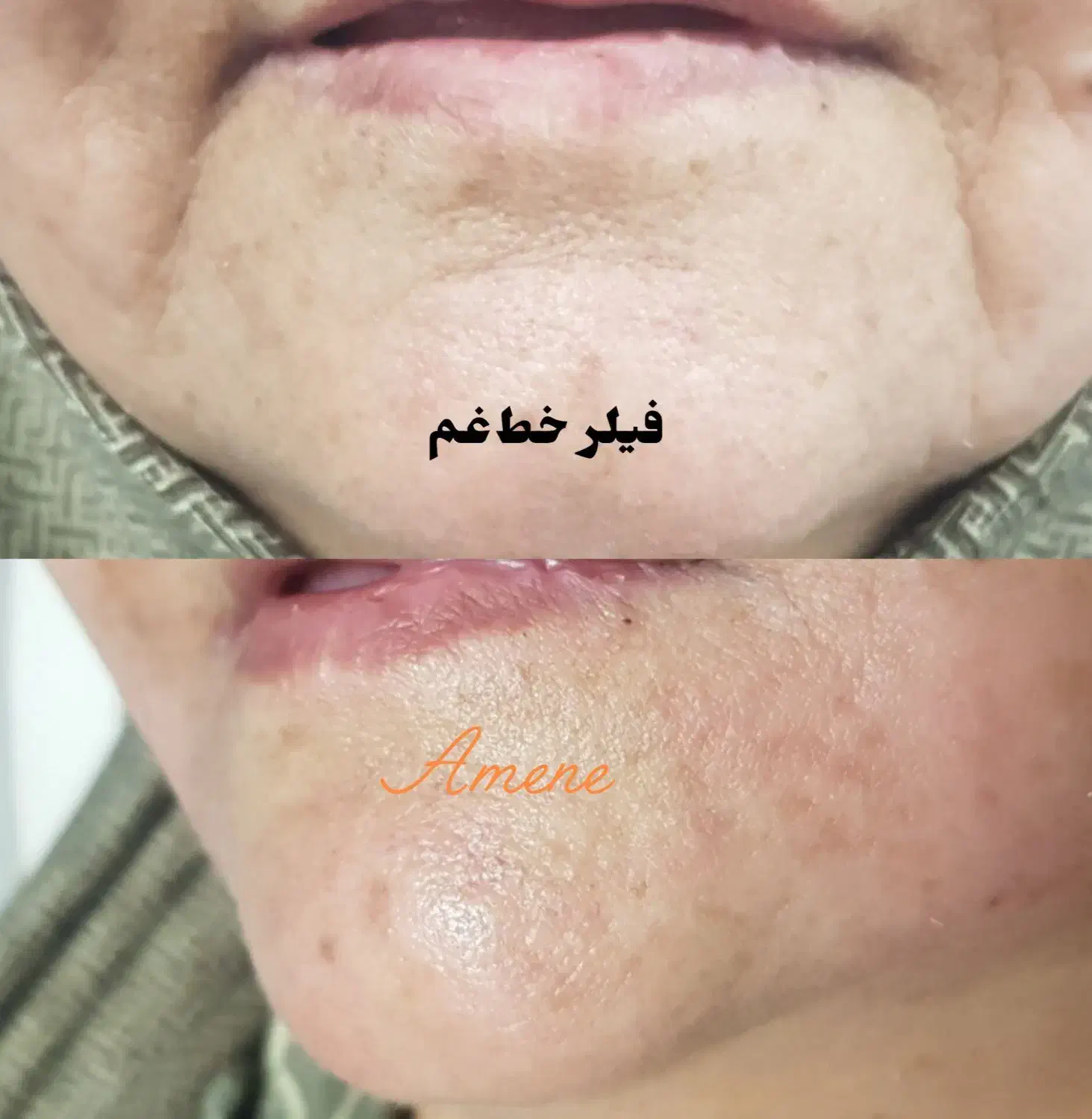 فیلر و بوتاکس تخفیف شب یلدا|خدمات آرایشگری و زیبایی|قم, باسکول|دیوار