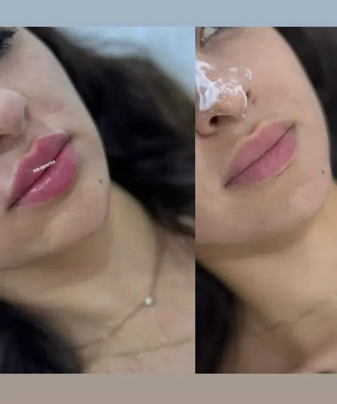 فیلر لب،چونه،گونه،فول فیس،باسن|خدمات آرایشگری و زیبایی|مشهد, سجاد شهر|دیوار