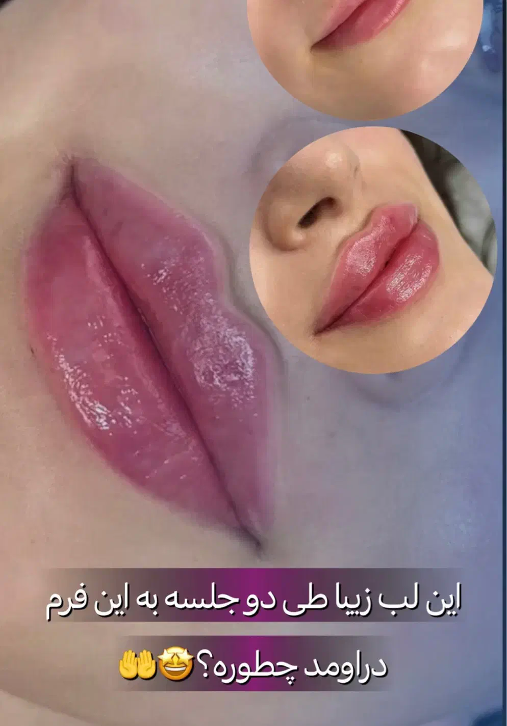 جشنواره تزریق چربی و فیلر به مناسبت روز دختر|خدمات آرایشگری و زیبایی|مریوان, |دیوار