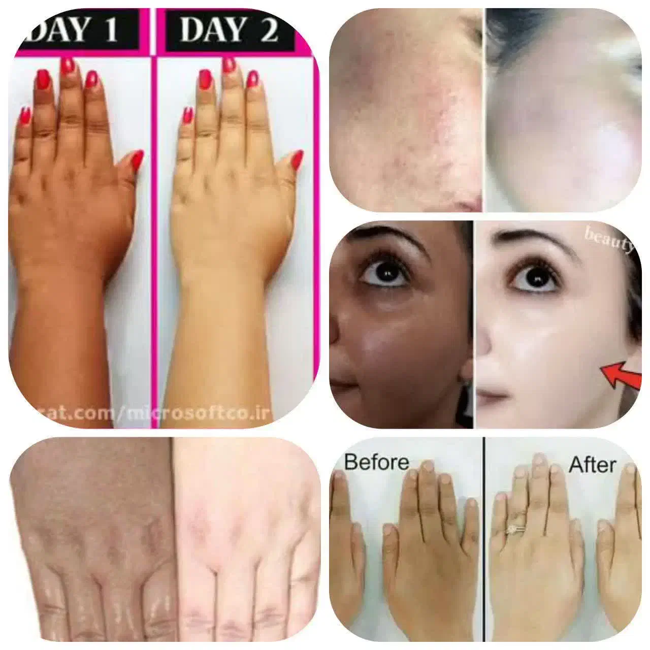 از تیرگی های صورت و بدنت خلاص شو|آرایشی، بهداشتی، درمانی|پشتکوه (سیستان و بلوچستان), |دیوار