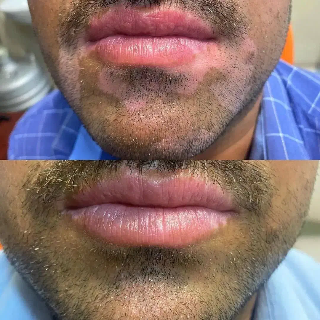 درمان پیسی و پسوریازیس|خدمات آرایشگری و زیبایی|کارون, |دیوار