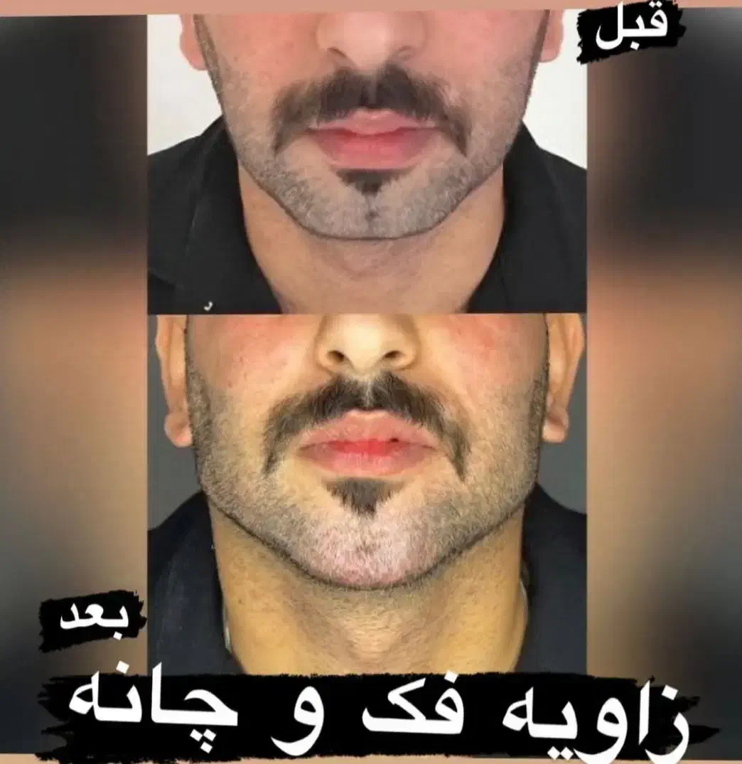 تزریق ژل و بوتاکس|خدمات آرایشگری و زیبایی|اصفهان, گلزار|دیوار