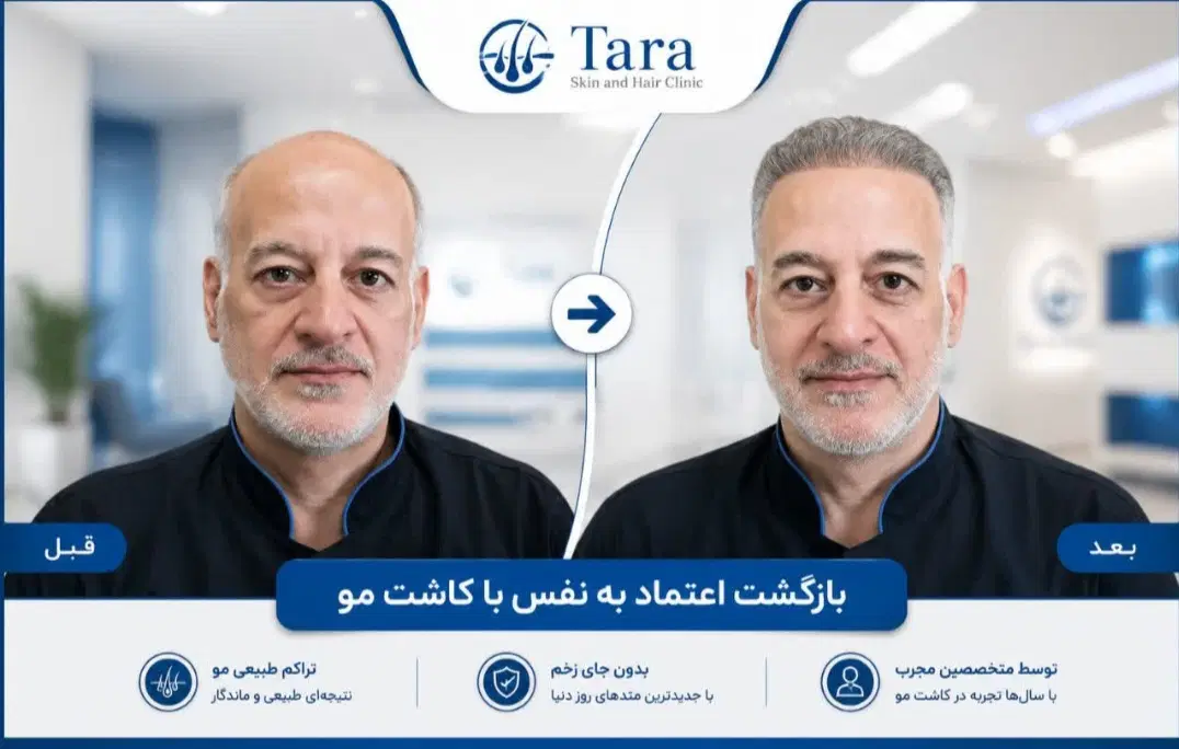 کاشت مو نقد و اقساط|خدمات زیبایی و سلامت|تهران, بلوار کشاورز|دیوار