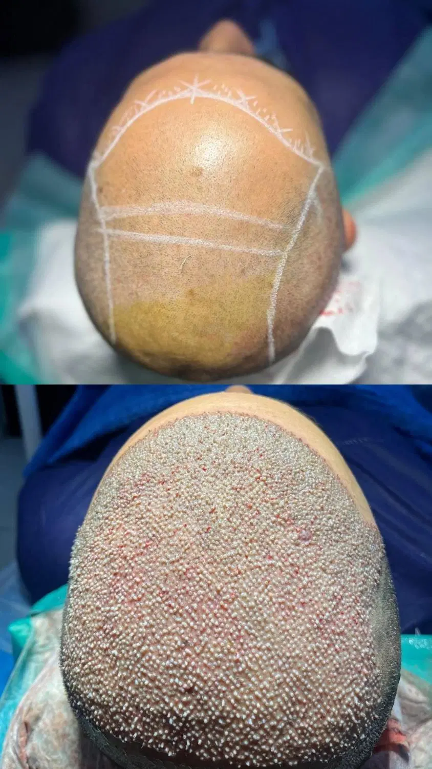 فول تراکم ترین کاشت مو شیراز با روش SMFIT|خدمات زیبایی و سلامت|شیراز, زرگری|دیوار