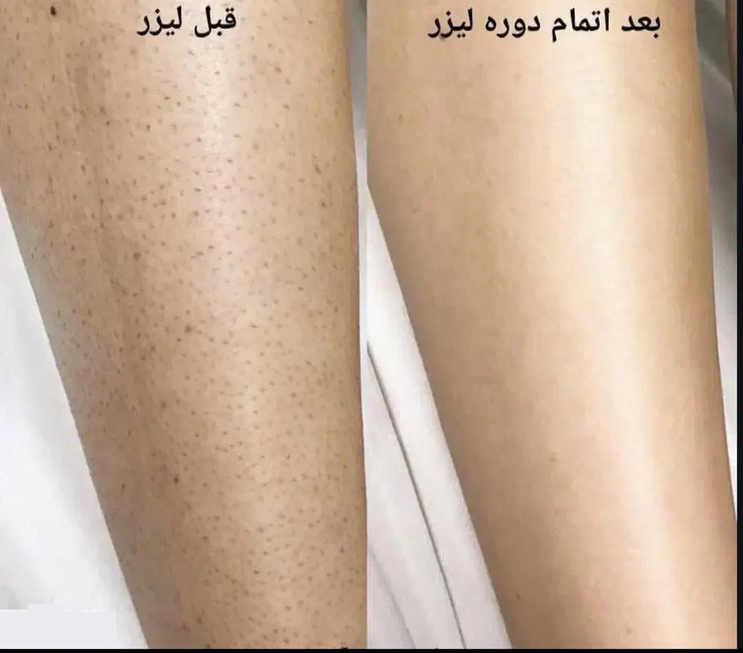لیزرموزائد سوپرانوتیتانیوم آلما اصلی|خدمات آرایشگری و زیبایی|گرگان, |دیوار
